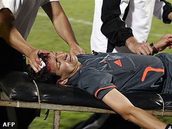 Article Футбольный арбитр получил тяжелую травму – с трибуны в него кинули камень